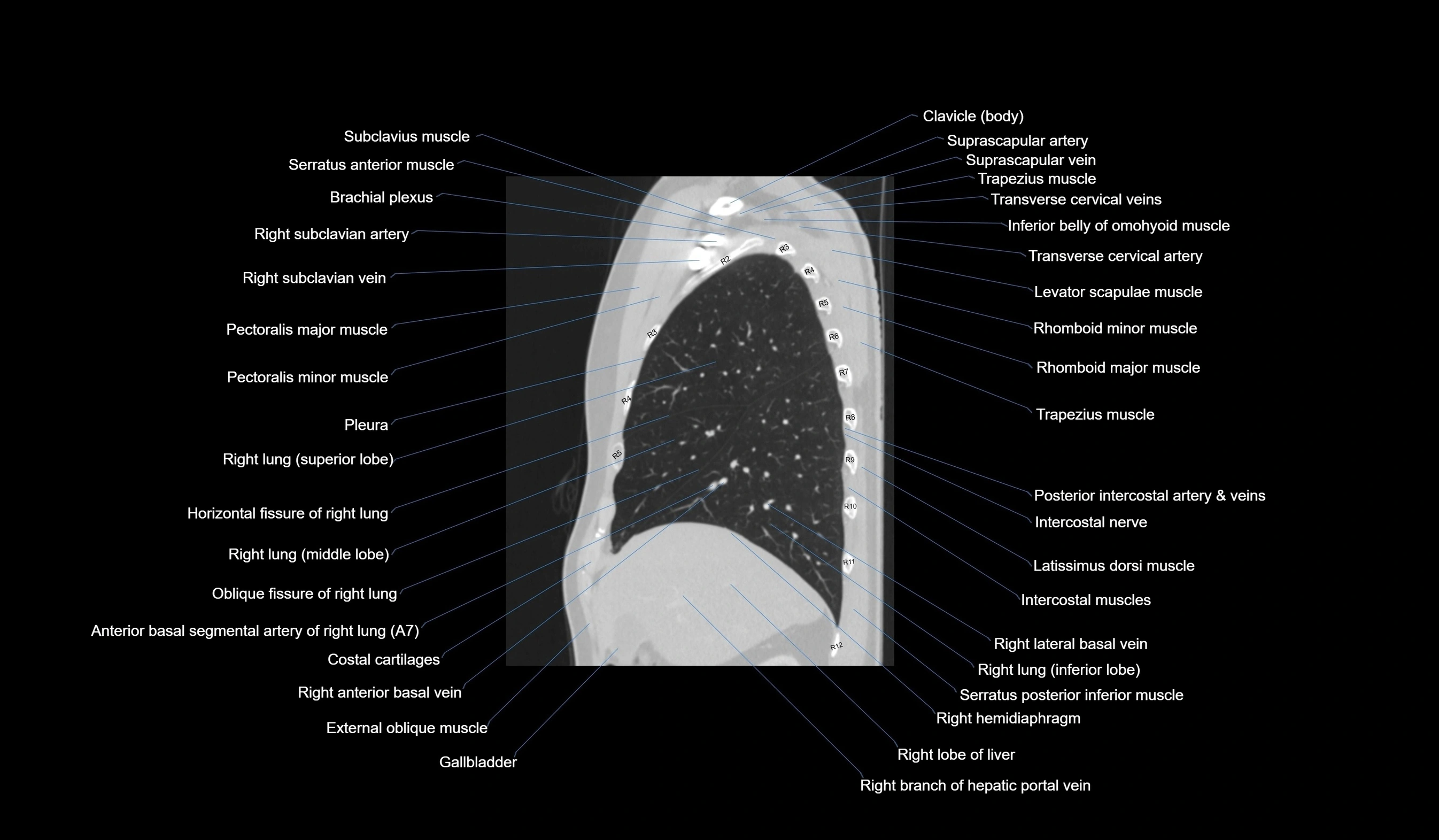 CT chest (thorax) lung window labelled sagittal cross sectional anatomy radiology image-00040.webp